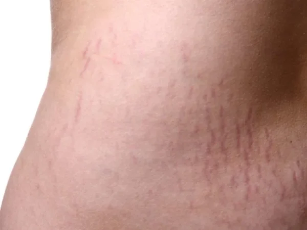 Stretch Mark Cream - Image 6